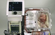 Europe’s first non-beating heart transplant